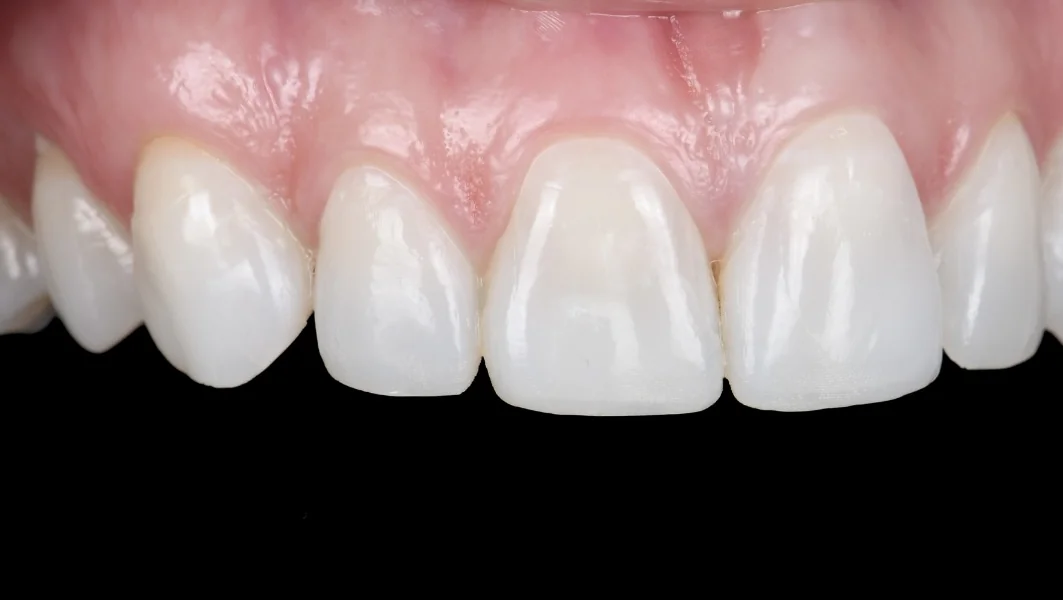 Sur contrasteur noir, après : les dents du haut harmonisées par le composite injecté, bords et proportions rétablis.