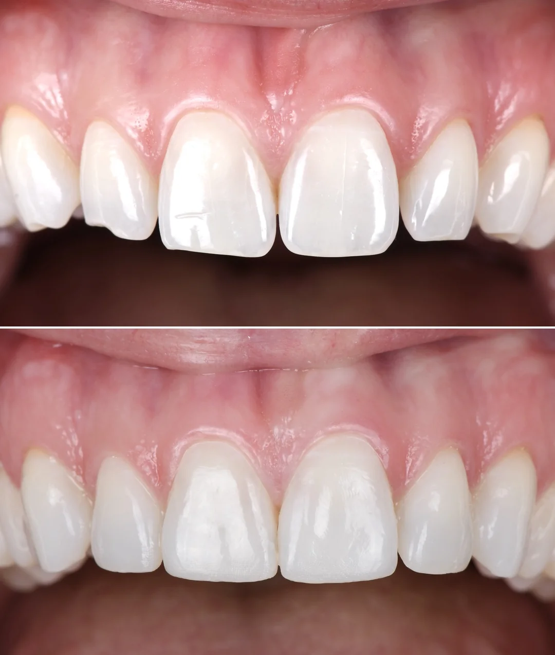 Dents écartées, avant et après : en haut, l’usure des bords libres des dents du haut ; en bas, les mêmes dents après le composite injecté, bords rétablis.