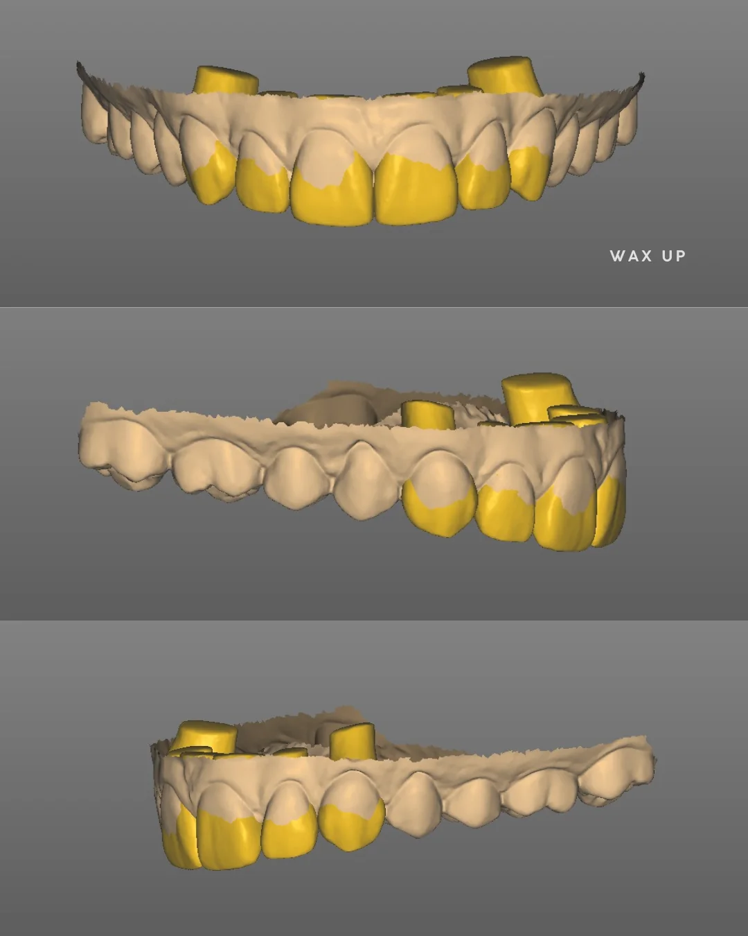 Trois vues du wax-up numérique sur le modèle : en jaune, les volumes dessinés sur les dents du haut, de face et de chaque côté.