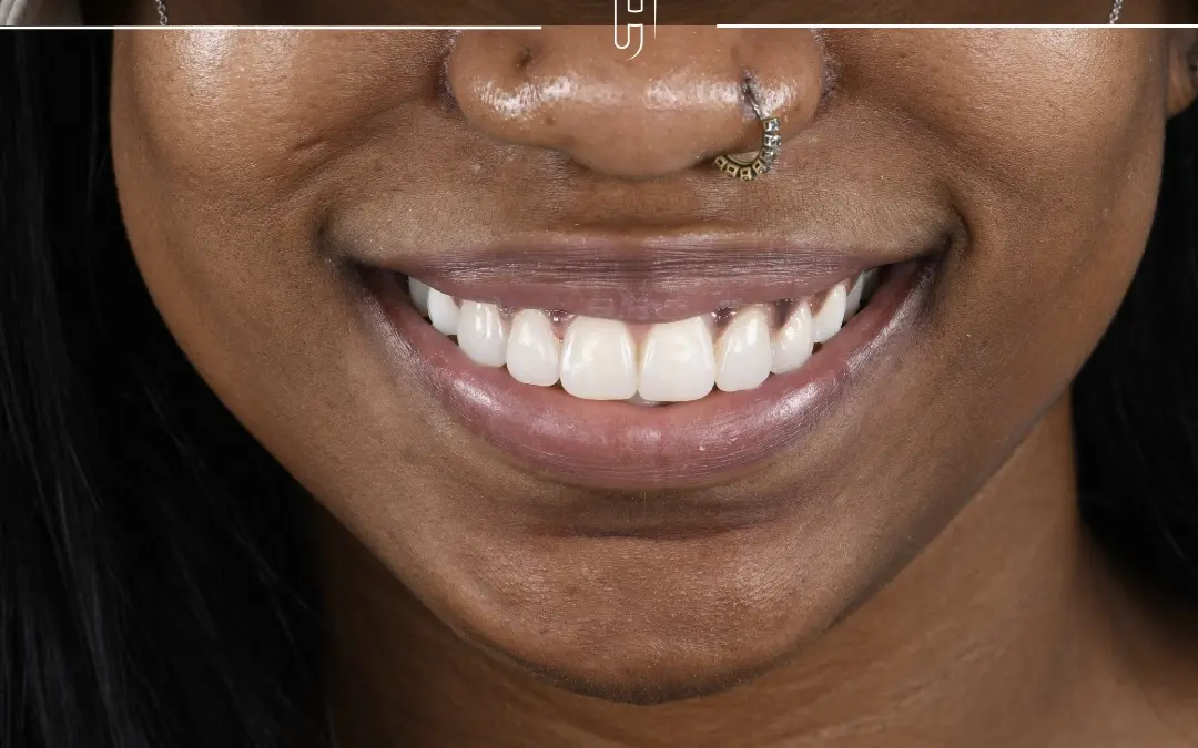 Le sourire après le traitement : proportions rééquilibrées par composite.