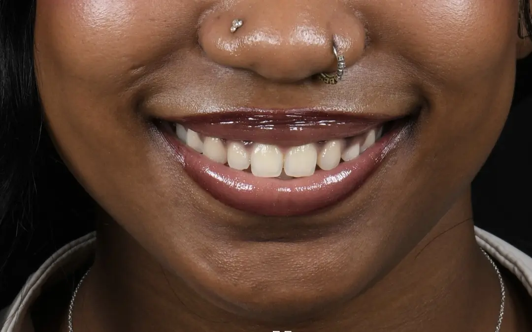 Le sourire avant le traitement : incisive latérale gauche absente, proportions déséquilibrées.
