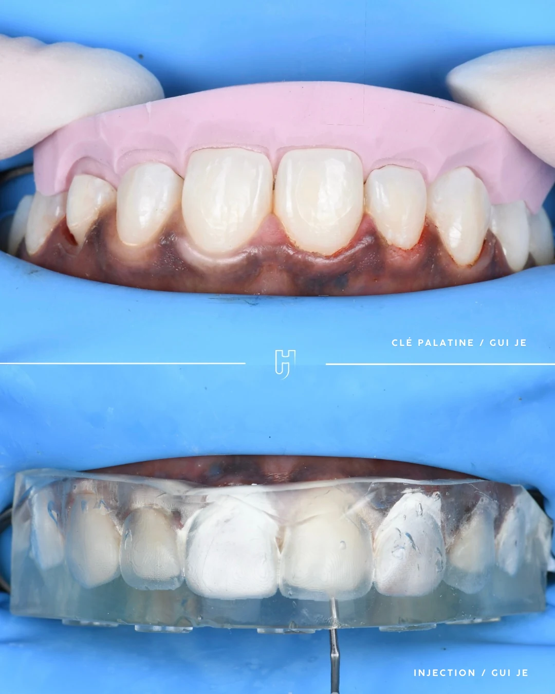 Deux vues sous digue bleue : en haut, une clé en silicone rose placée derrière les dents du haut ; en bas, un guide transparent posé sur les dents pour l’injection du composite.