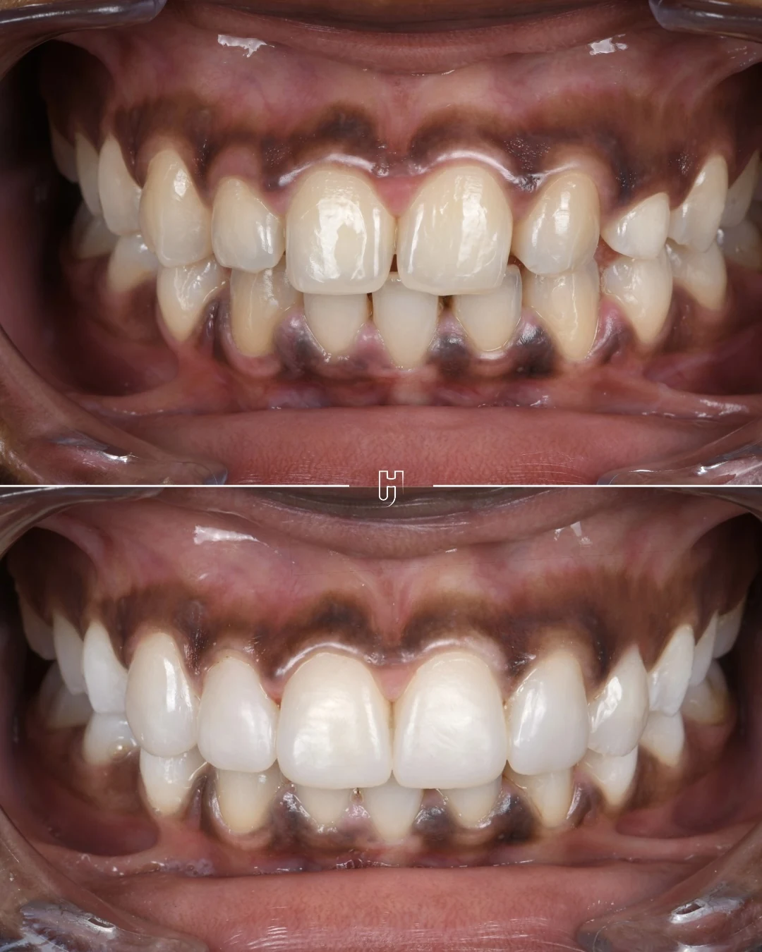 Comparaison intra-buccale avant et après restauration du sourire par stratification et composite injecté