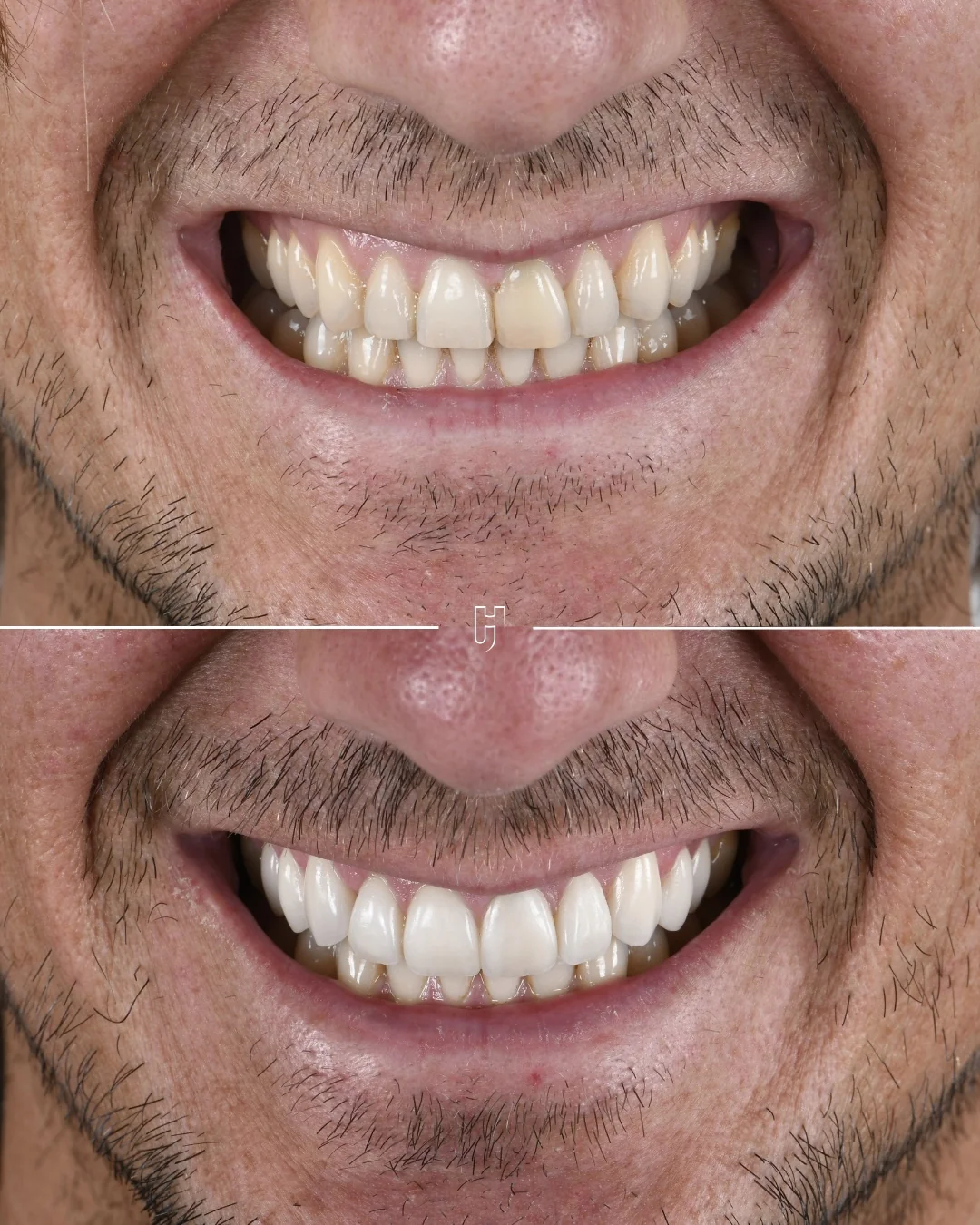 Avant et après dix facettes céramiques : le sourire de face, des dents plus jaunes et irrégulières, puis plus claires et régulières.