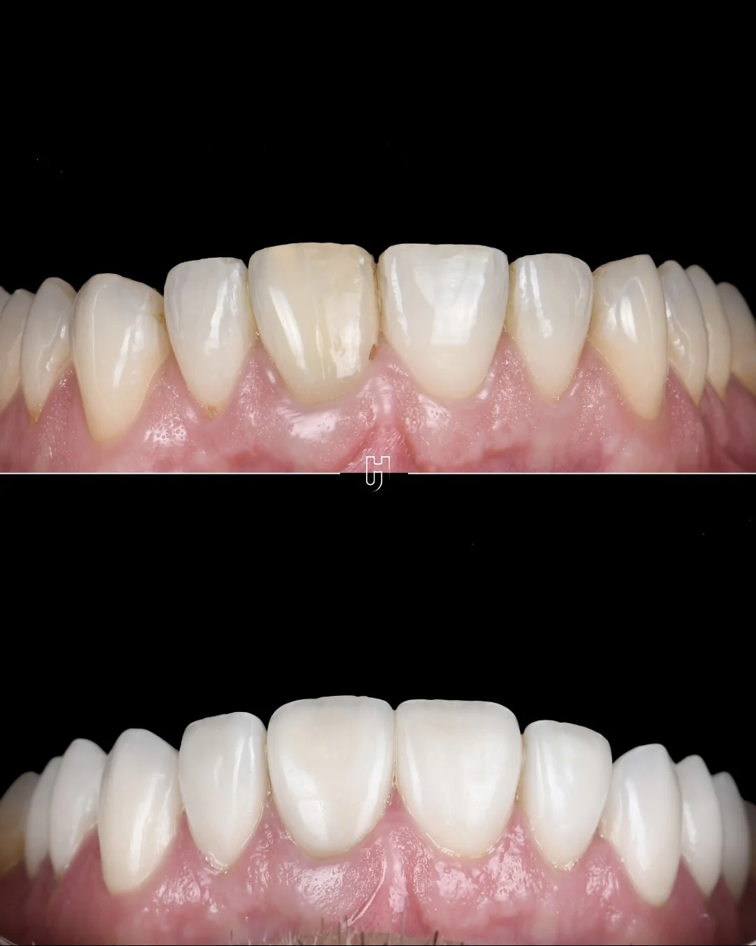 Sur fond noir, les dents du haut de près : en haut avant le traitement, une incisive plus sombre que ses voisines ; en bas après la pose des facettes, une teinte homogène.