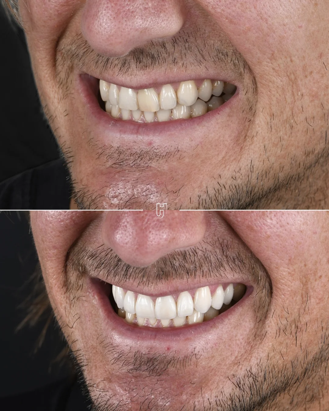 Le sourire de trois quarts, avant en haut et après en bas : des dents plus claires et des formes plus régulières après les facettes.