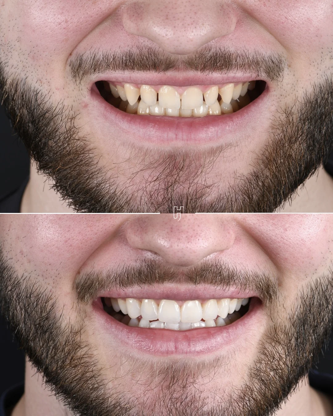 Avant et après six facettes en composite injecté : les espaces entre les dents du haut refermés.