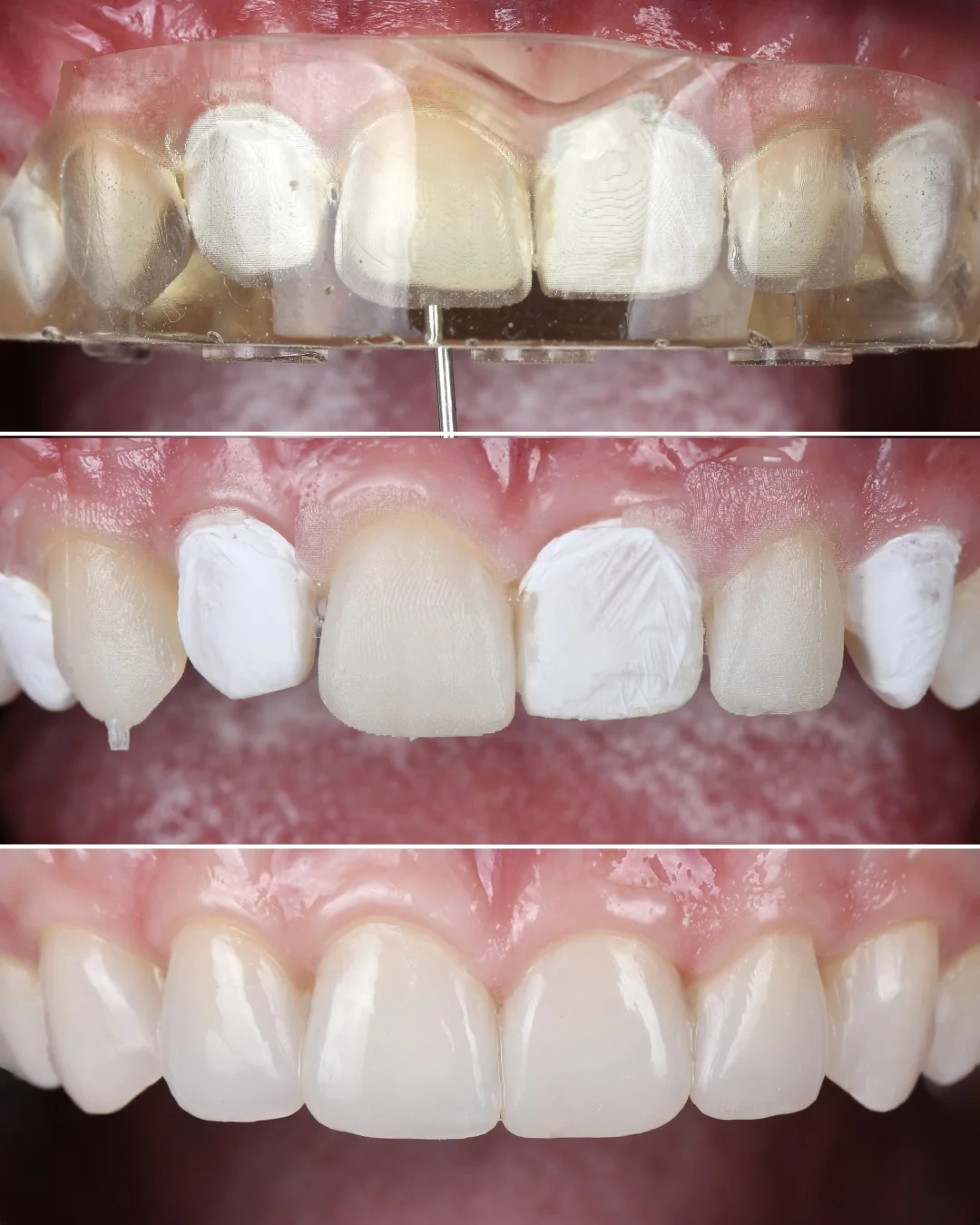 Trois étapes de l’injection : la clé transparente en place sur les dents, le composite injecté une dent sur deux avant finitions, les six dents terminées.