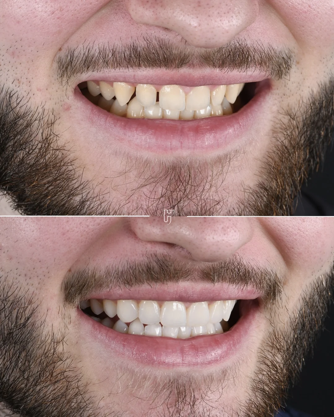Avant et après, de trois quarts : les espaces entre les dents du haut refermés et les canines adoucies par les facettes en composite injecté.