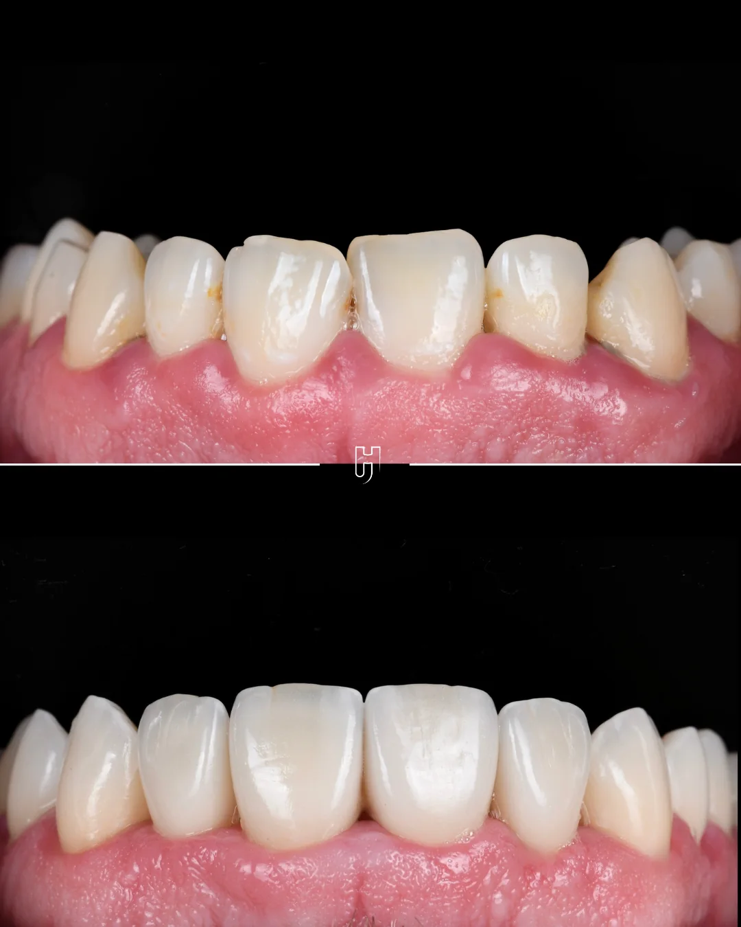 Avant et après huit facettes feldspathiques sur les dents supérieures, en vue rapprochée.