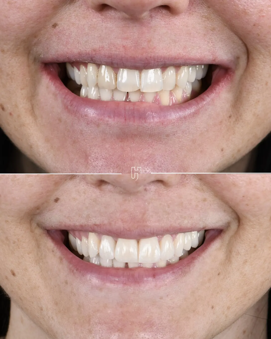 Sourire avant et après le remplacement d’une facette et la pose de quatre facettes céramiques feldspathiques sur les incisives