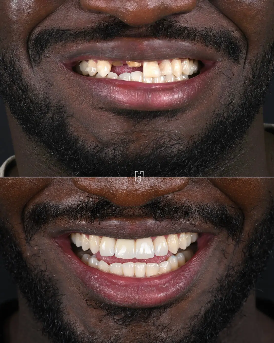Avant et après la réhabilitation des dents antérieures après un accident
