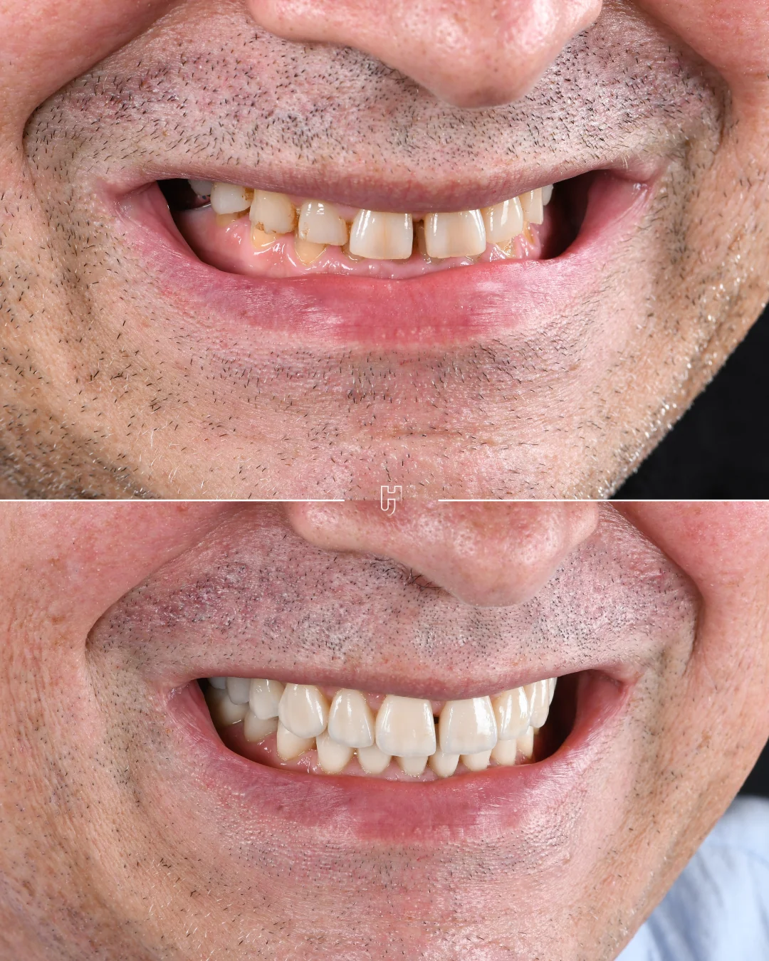Avant et après la réhabilitation d’un sourire usé par le bruxisme : des dents courtes et usées en haut, reconstruites en bas.