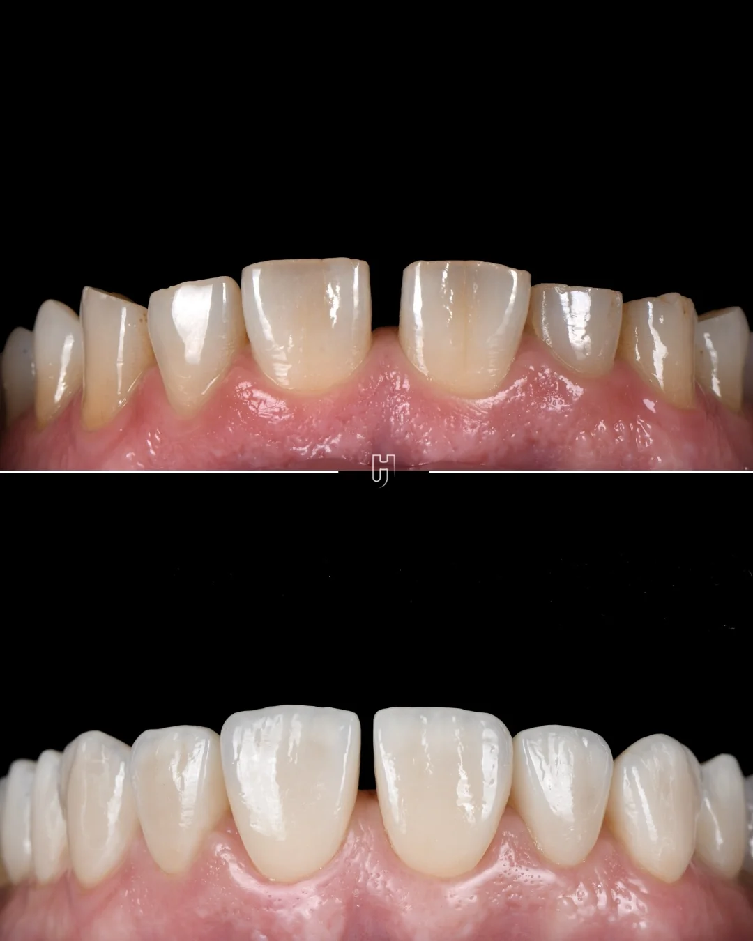 Avant et après, les dents du haut vues de face sur fond noir : des bords libres usés et irréguliers, puis des bords reconstruits, réguliers d’une dent à l’autre.