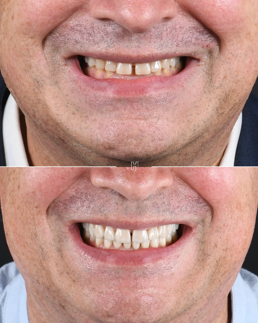 Avant et après, le sourire d’un homme vu de face : des dents usées et raccourcies, puis des dents reconstruites en céramique, plus longues et plus claires.