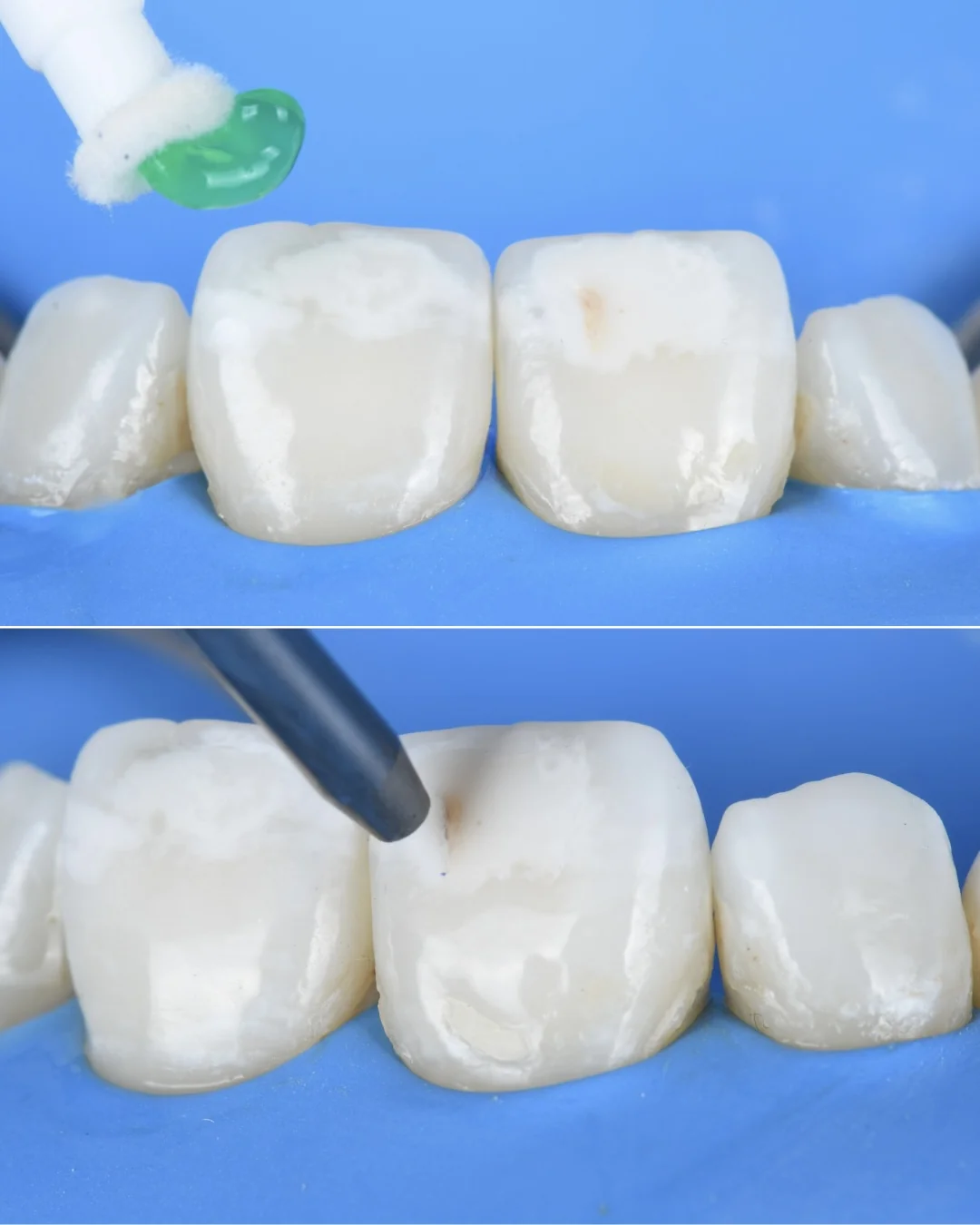 Sous digue, deux étapes : en haut, le gel d’érosion vert appliqué sur l’incisive ; en bas, l’embout du micro-sablage sur la tache.