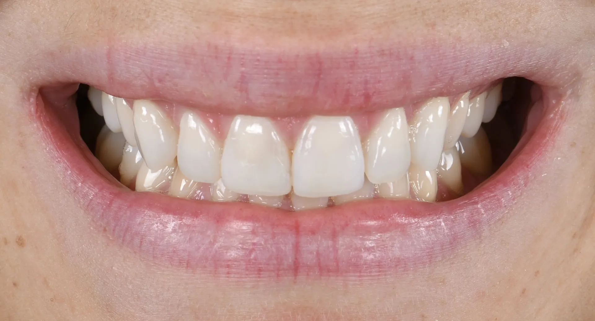 Le même sourire après composite injecté.