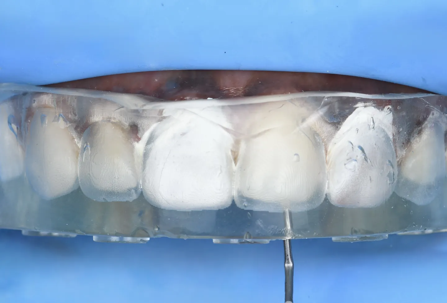 Sous digue bleue, la clé transparente en place sur les dents du haut, un embout d’injection engagé dans la clé.