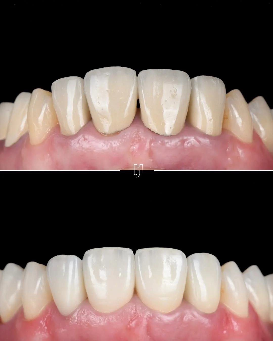 Sur fond noir, les dents du haut présentées retournées : en haut, les anciennes couronnes céramo-métalliques ; en bas, les couronnes en zircone stratifiée.