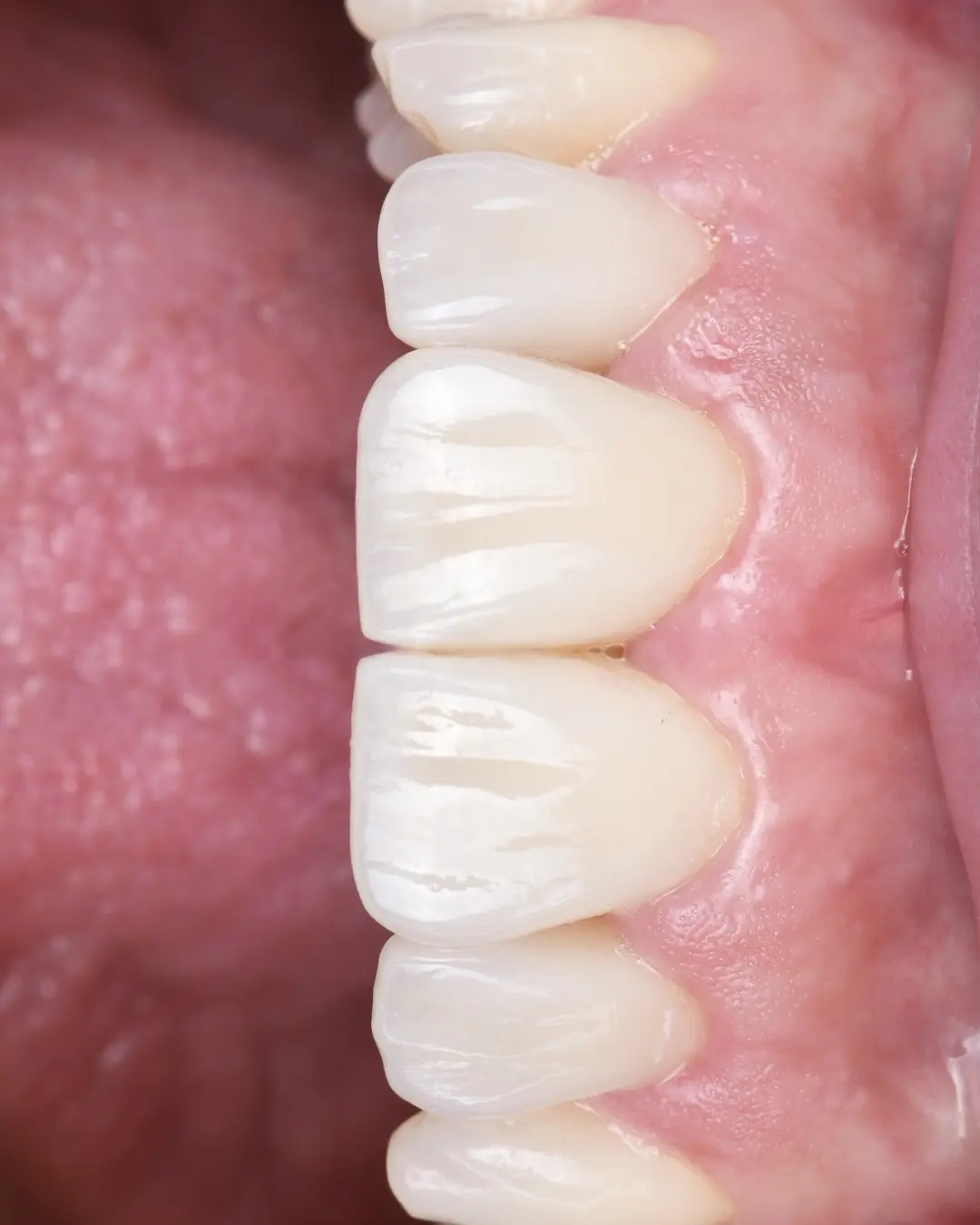 Détail de texture et de translucidité des dents antérieures