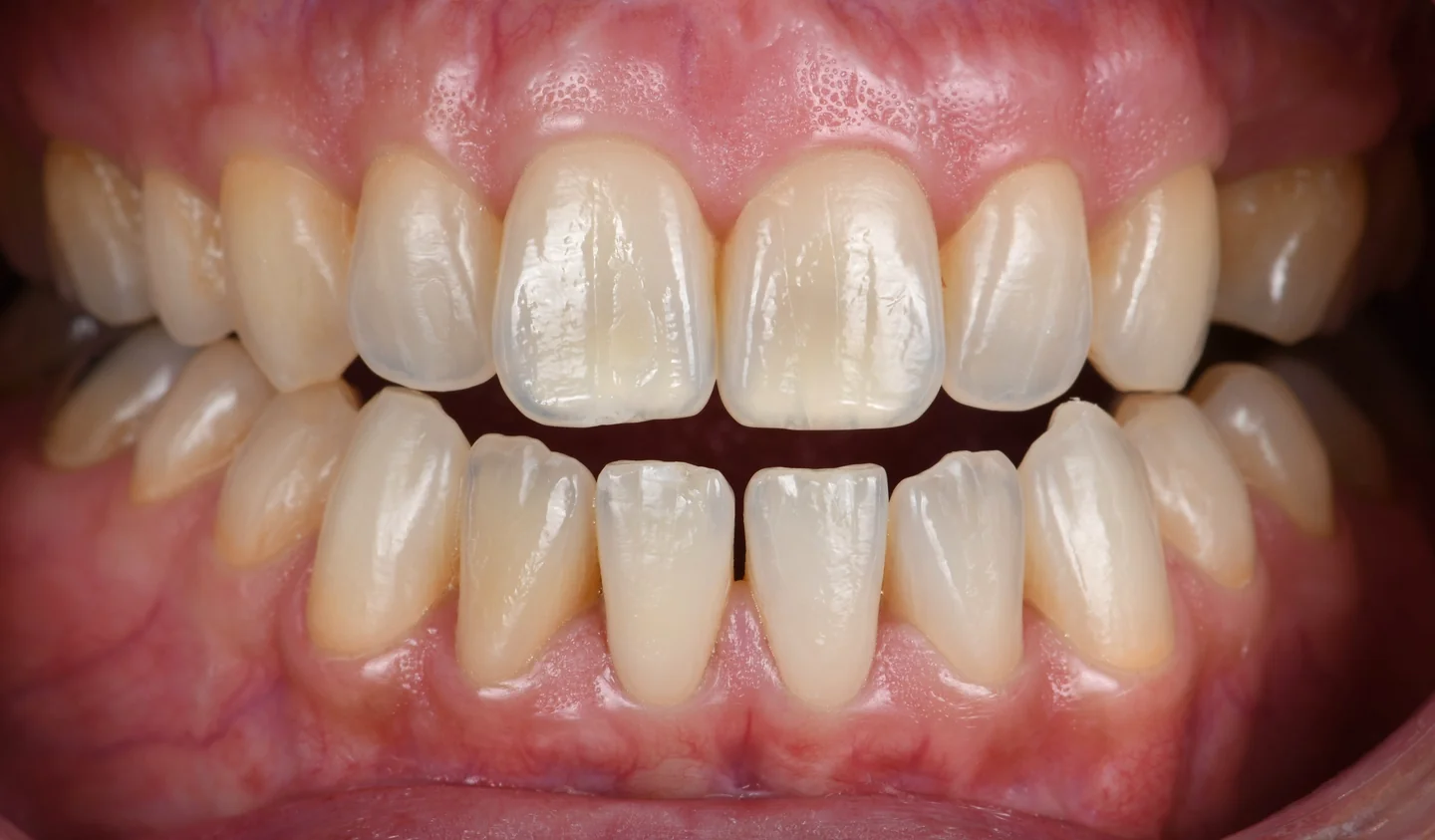 Les mêmes dents après le traitement, plus claires, vues de face.