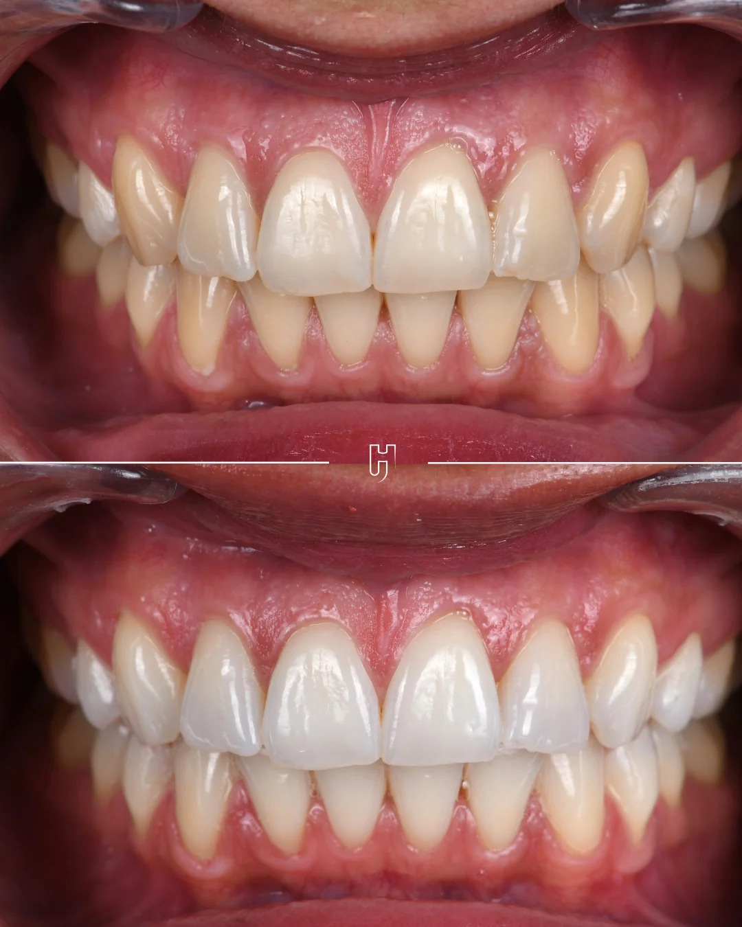 Avant et après un éclaircissement : les mêmes dents, plus jaunes en haut, plus claires en bas.