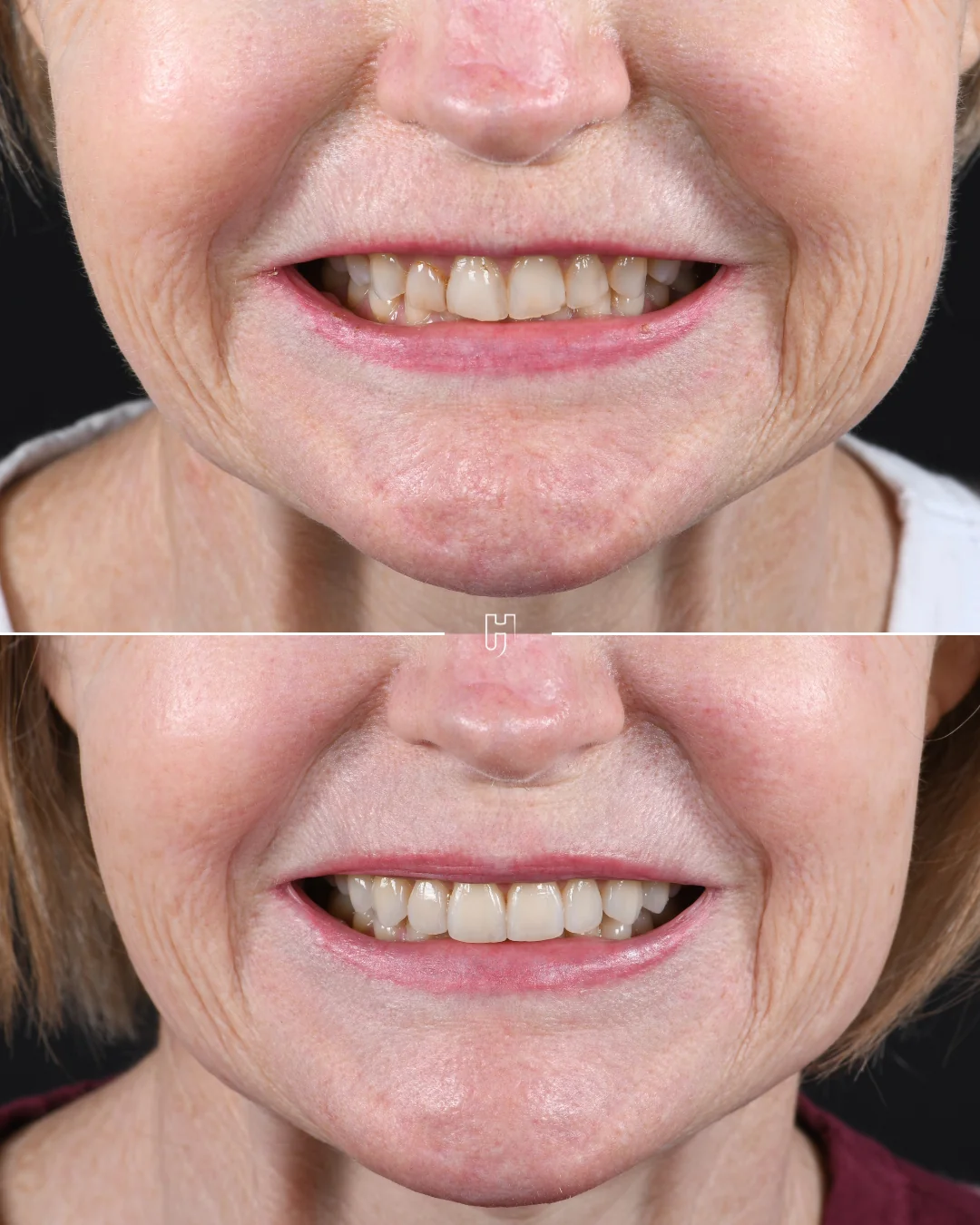 Le sourire de face, avant et après : en haut les dents usées, en bas les huit facettes.