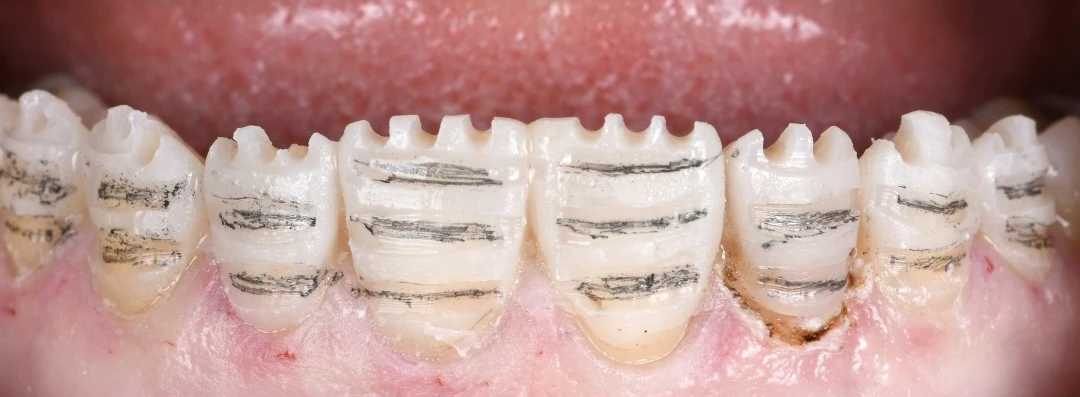 Les dents du haut en cours de préparation pour des facettes : des rainures de profondeur, marquées au crayon, sur chaque dent.