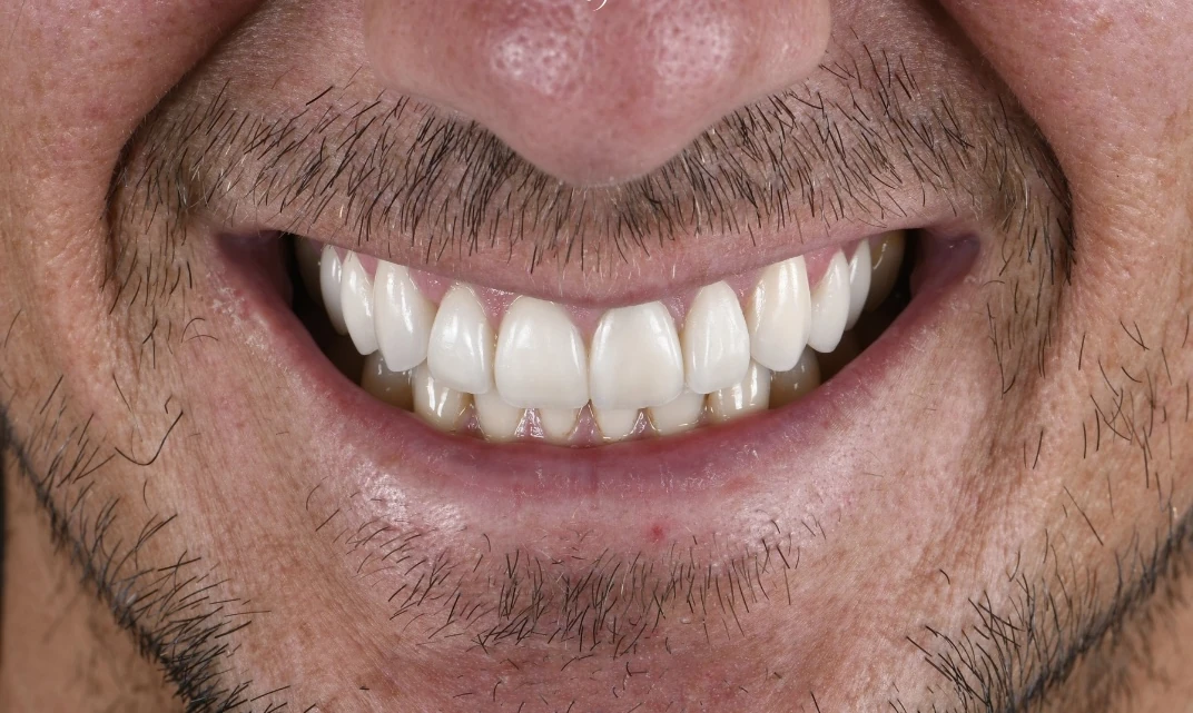 Le même sourire après la pose de dix facettes sur les dents du haut.