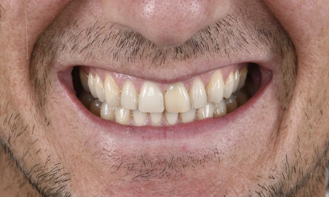 Le sourire d’un patient avant le traitement : les dents du haut, plus jaunes et irrégulières.