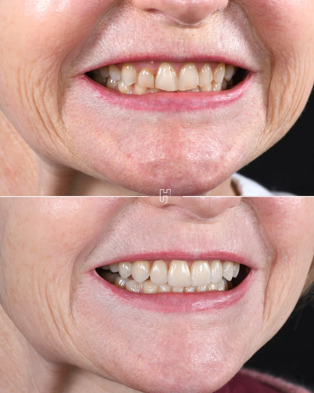 Le sourire de trois quarts, avant et après : en haut, des dents usées et ternes ; en bas, huit facettes en disilicate de lithium qui redonnent leurs formes aux dents.