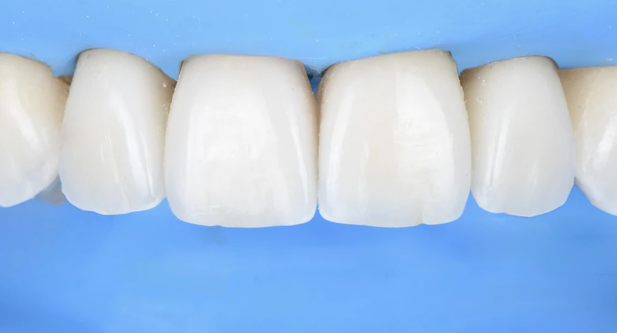 Facettes céramiques en place sur les dents antérieures supérieures, isolées sous digue.