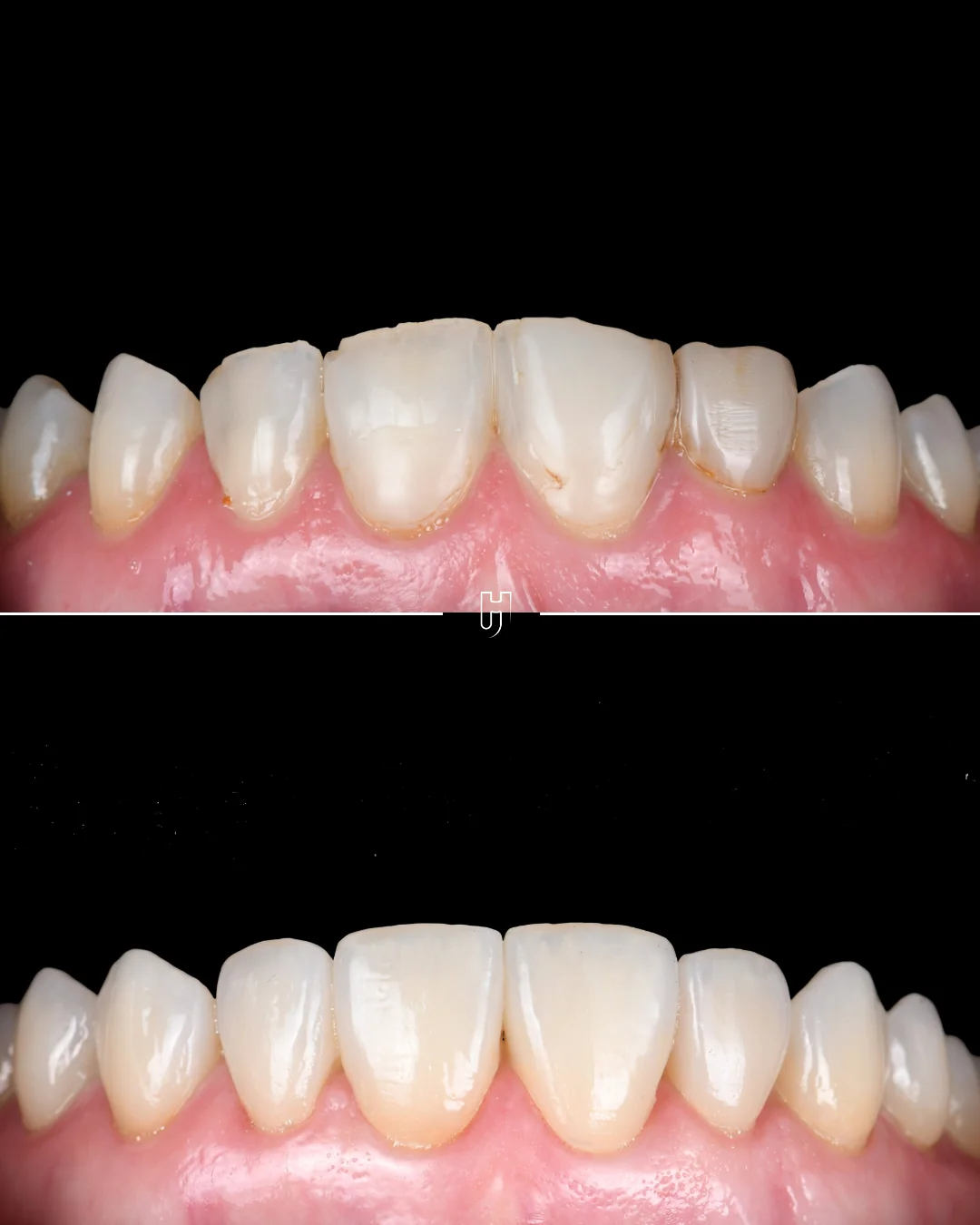 Sur fond noir, présentées retournées : en haut, les dents usées avant le traitement ; en bas, les huit facettes en disilicate de lithium.