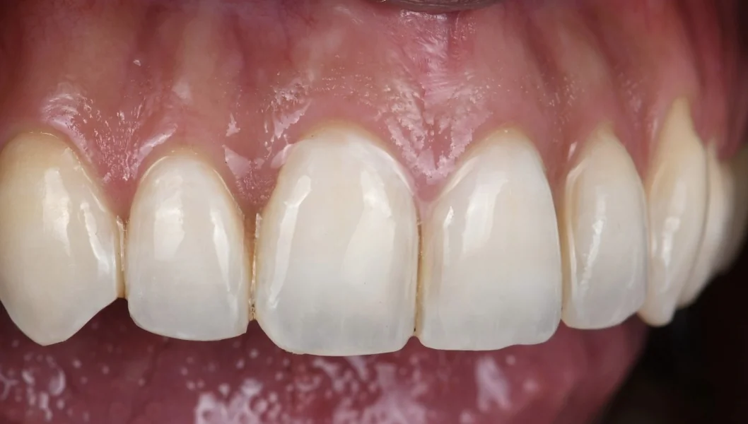 Les mêmes dents après l’éclaircissement et l’érosion-infiltration Icon : une teinte plus homogène, les opacités atténuées.