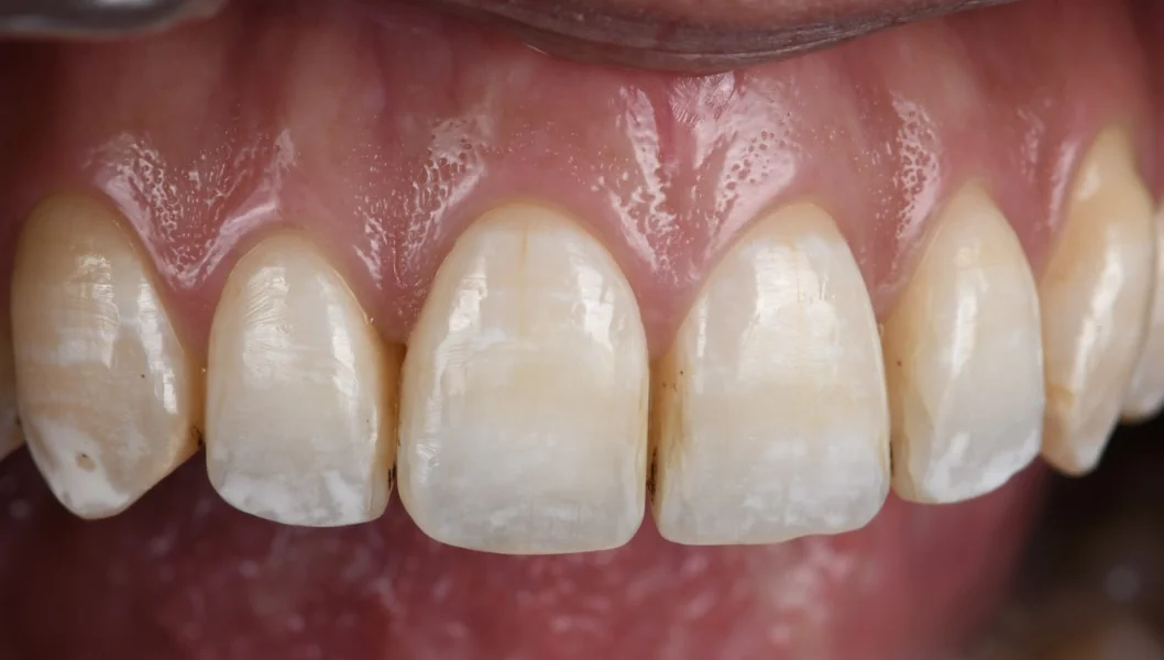 Les dents du haut de trois quarts, avant le traitement : des taches blanches de fluorose sur les dents antérieures.