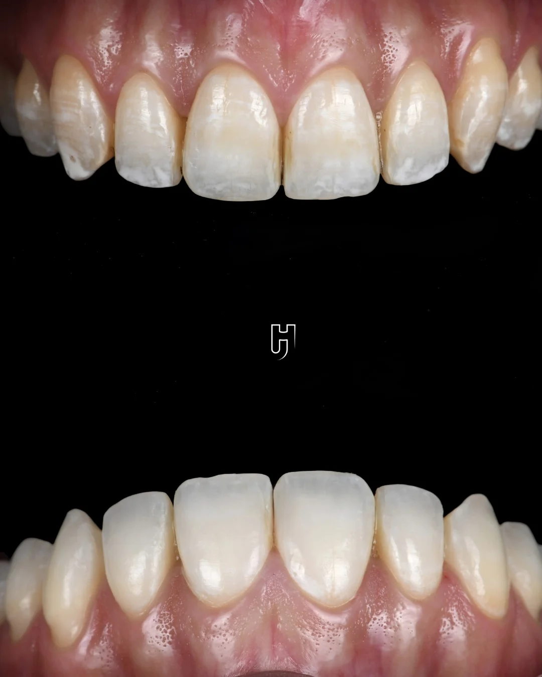 De face, sur fond noir : en haut, les dents avant le traitement, avec des taches blanches de fluorose ; en bas, les mêmes dents après, image retournée.