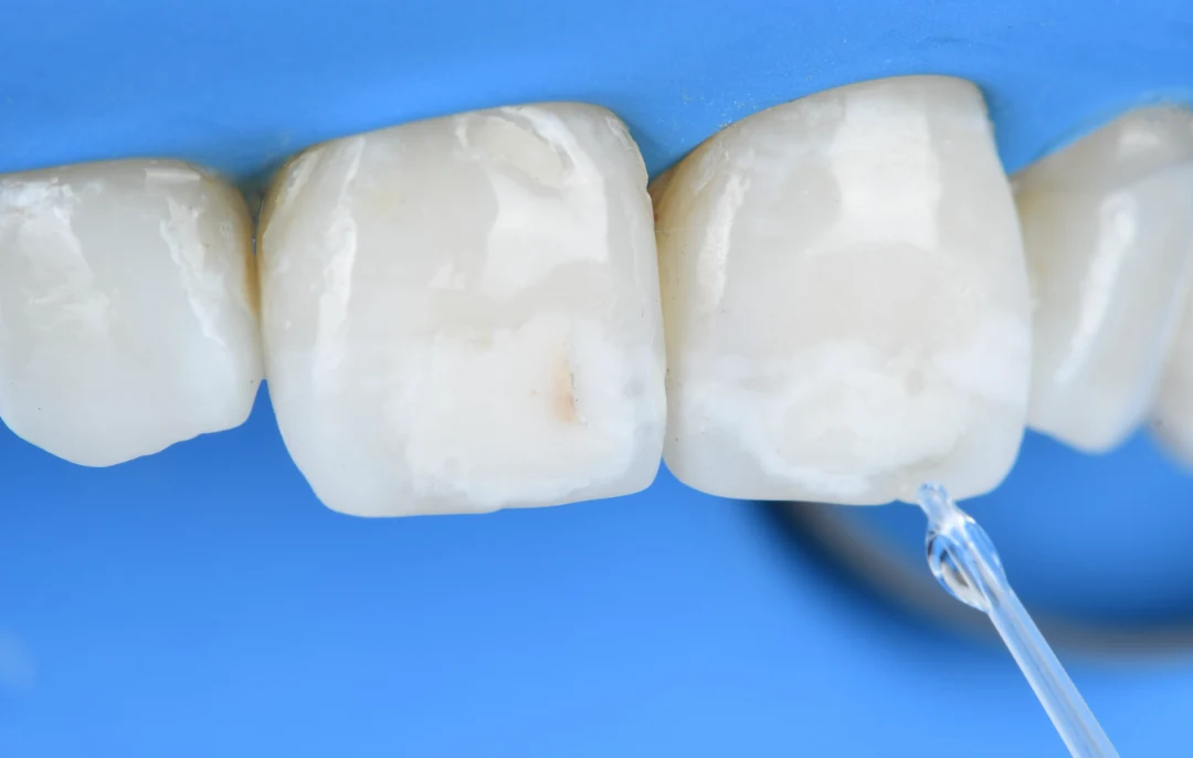 Goutte d’Icon-Dry déposée à la pipette sur les incisives isolées sous digue