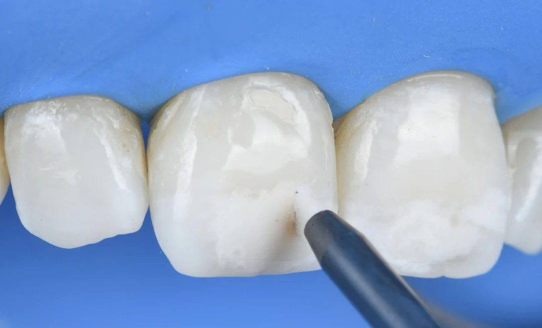 Sous digue, embout de sablage dirigé sur la fine ligne brune d’une incisive centrale