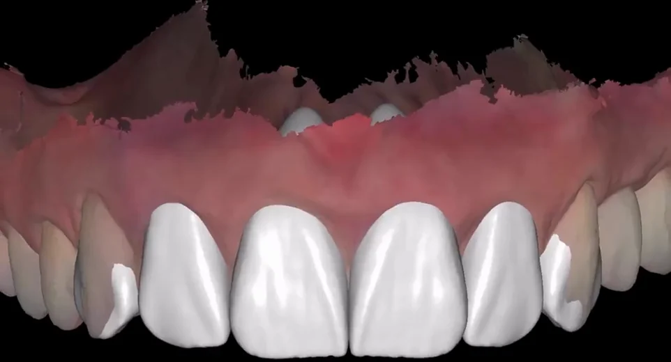 Simulation numérique d’un projet de facettes sur un modèle des dents en trois dimensions