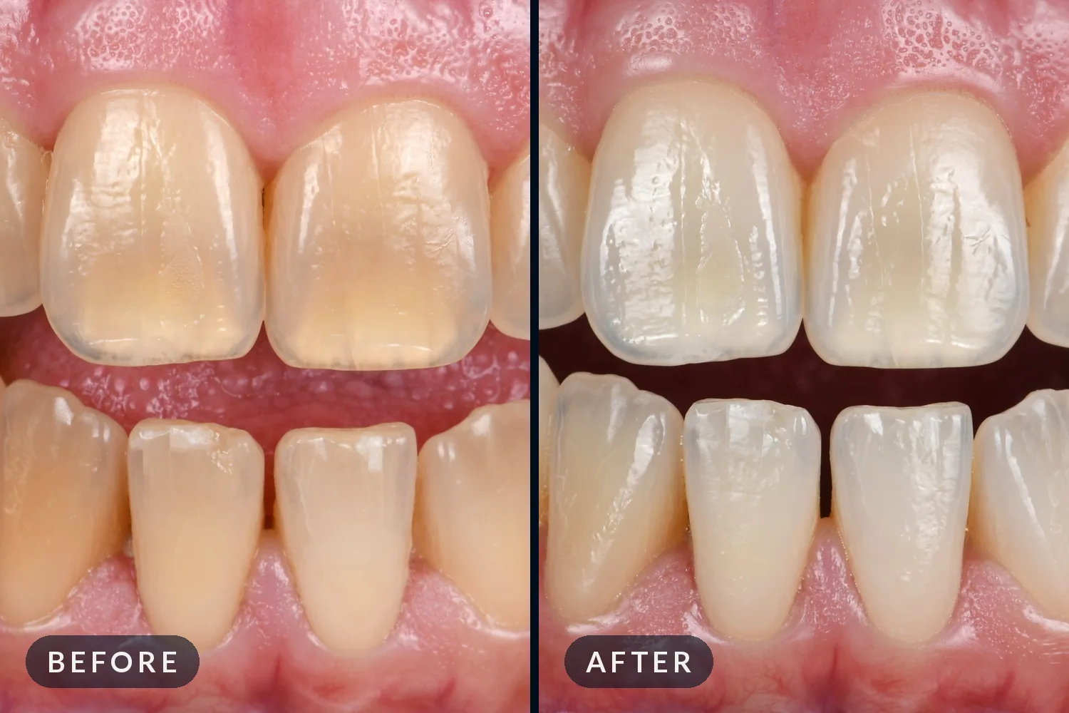 The same incisors before and after whitening: more yellow on the left, lighter on the right