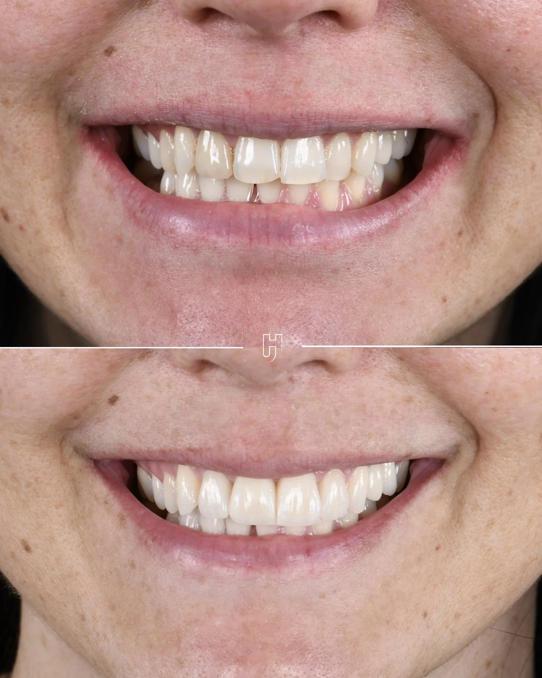 Avant et après quatre facettes feldspathiques : le sourire de face, une incisive latérale plus large et plus saturée, puis des dents harmonieuses.