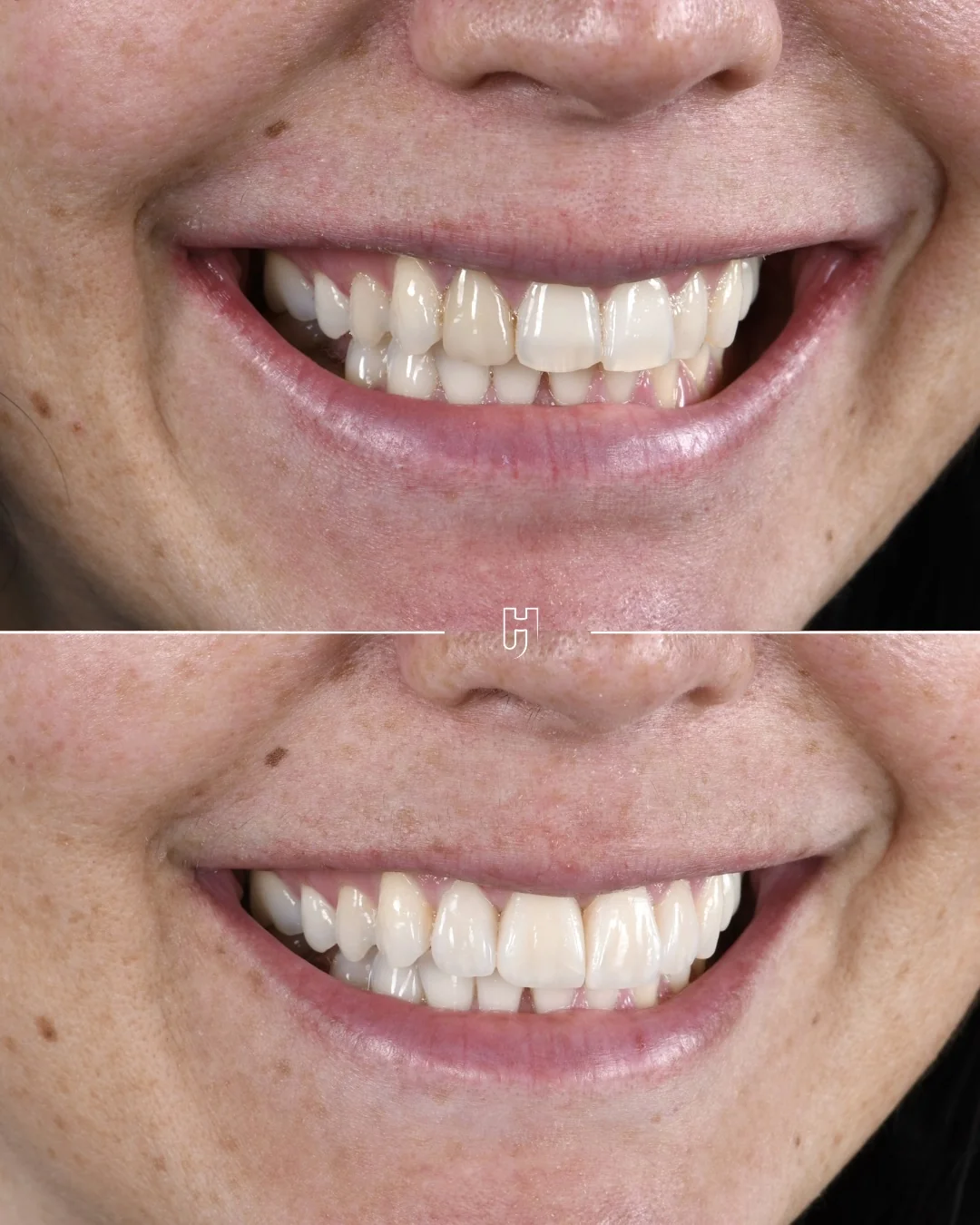 Le sourire de trois quarts, avant en haut et après en bas : l’ancienne facette remplacée, des proportions et une teinte harmonisées.