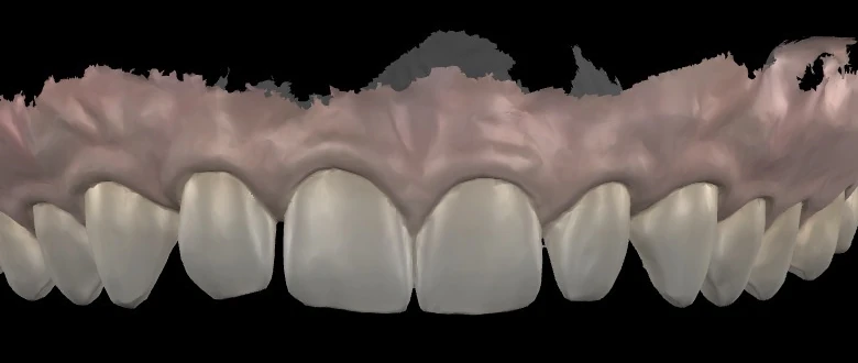 Empreinte numérique de l’arcade du haut avant tout projet : les dents de devant, des espaces entre certaines d’entre elles, la gencive.