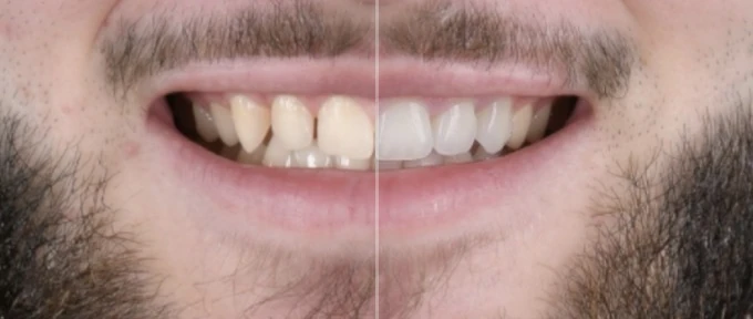 Bas du visage d’un patient souriant, sur une photographie partagée en deux : à gauche ses dents actuelles, plus jaunes et irrégulières, à droite la simulation, aux dents plus claires et plus régulières.