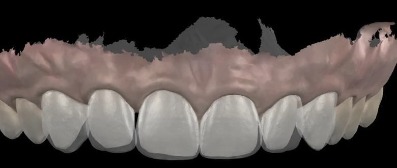 Wax-up numérique : les formes proposées, en blanc translucide, posées sur l’empreinte des dents du haut, plus longues et plus larges que les dents d’origine, visibles par transparence.
