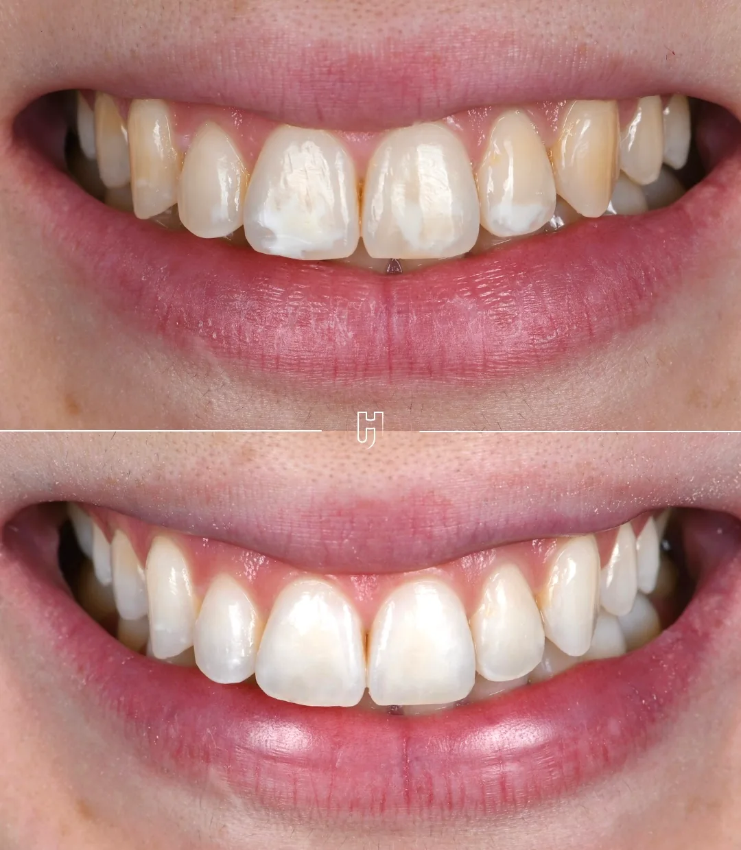 Le sourire de face, avant et après : en haut, des taches blanches marquées sur les dents de devant ; en bas, un sourire plus lumineux et plus homogène.