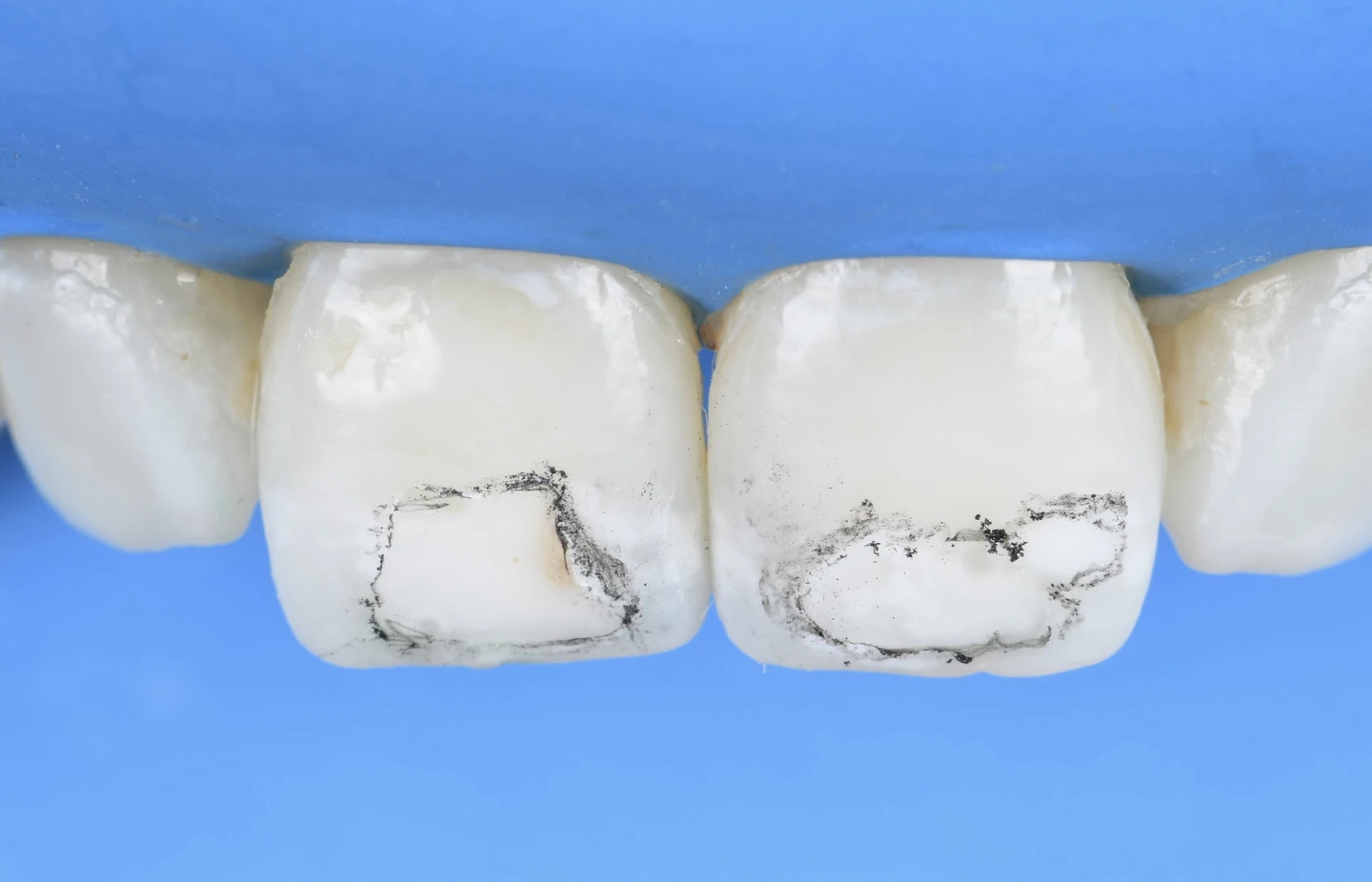 Contours des taches délimités sur les incisives centrales.