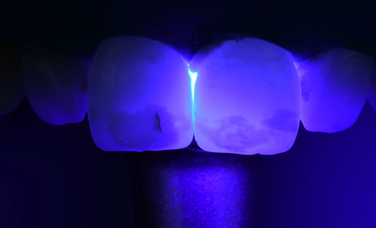 Examen des taches des incisives par transillumination.