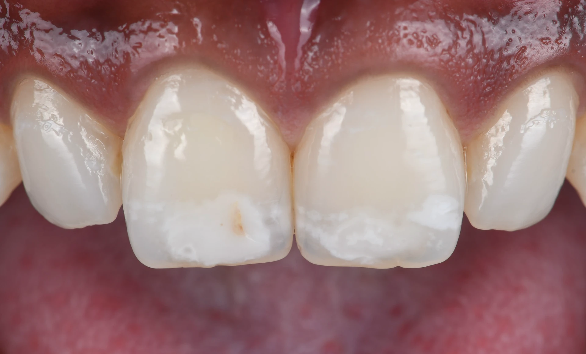 Taches blanches sur les dents de devant avant traitement : opacités au tiers incisif des deux incisives centrales et fine ligne brune sur l’une d’elles