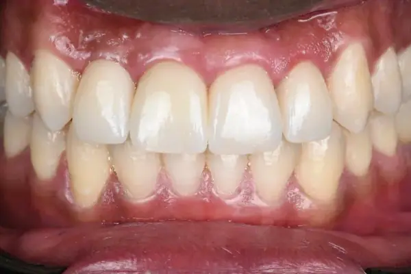 Les dents vues de face, après la restauration des dents de devant.